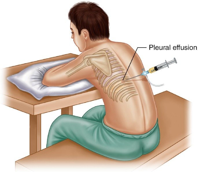 Pleural Aspiration
