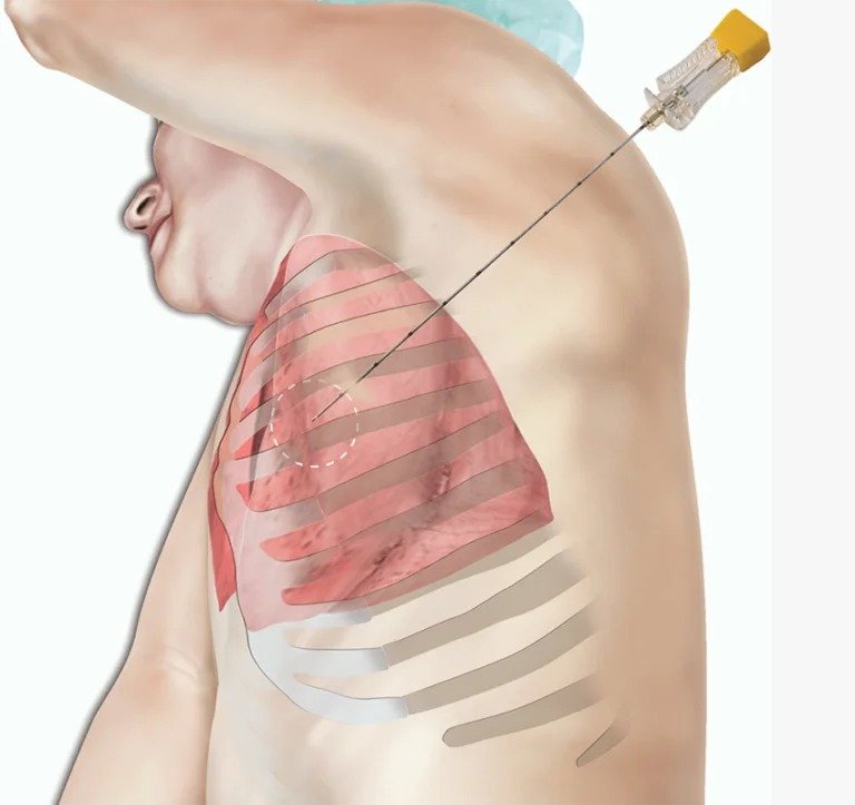 Pleural Biopsy