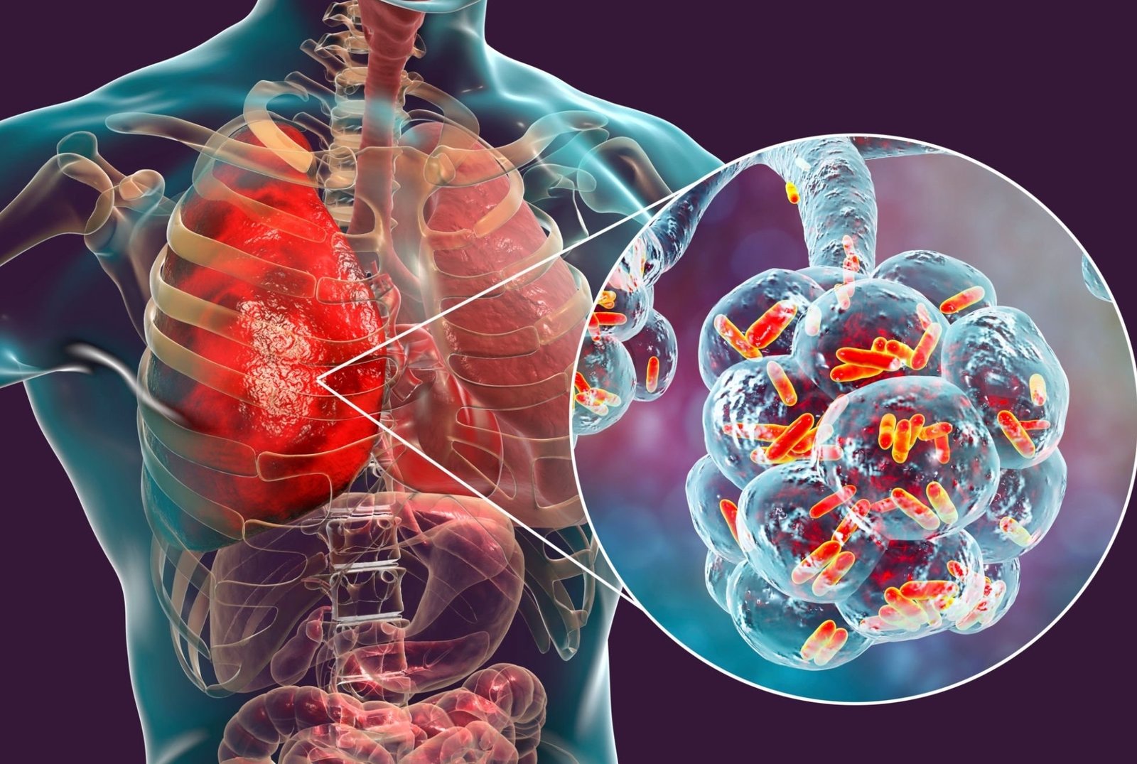 Tuberculosis