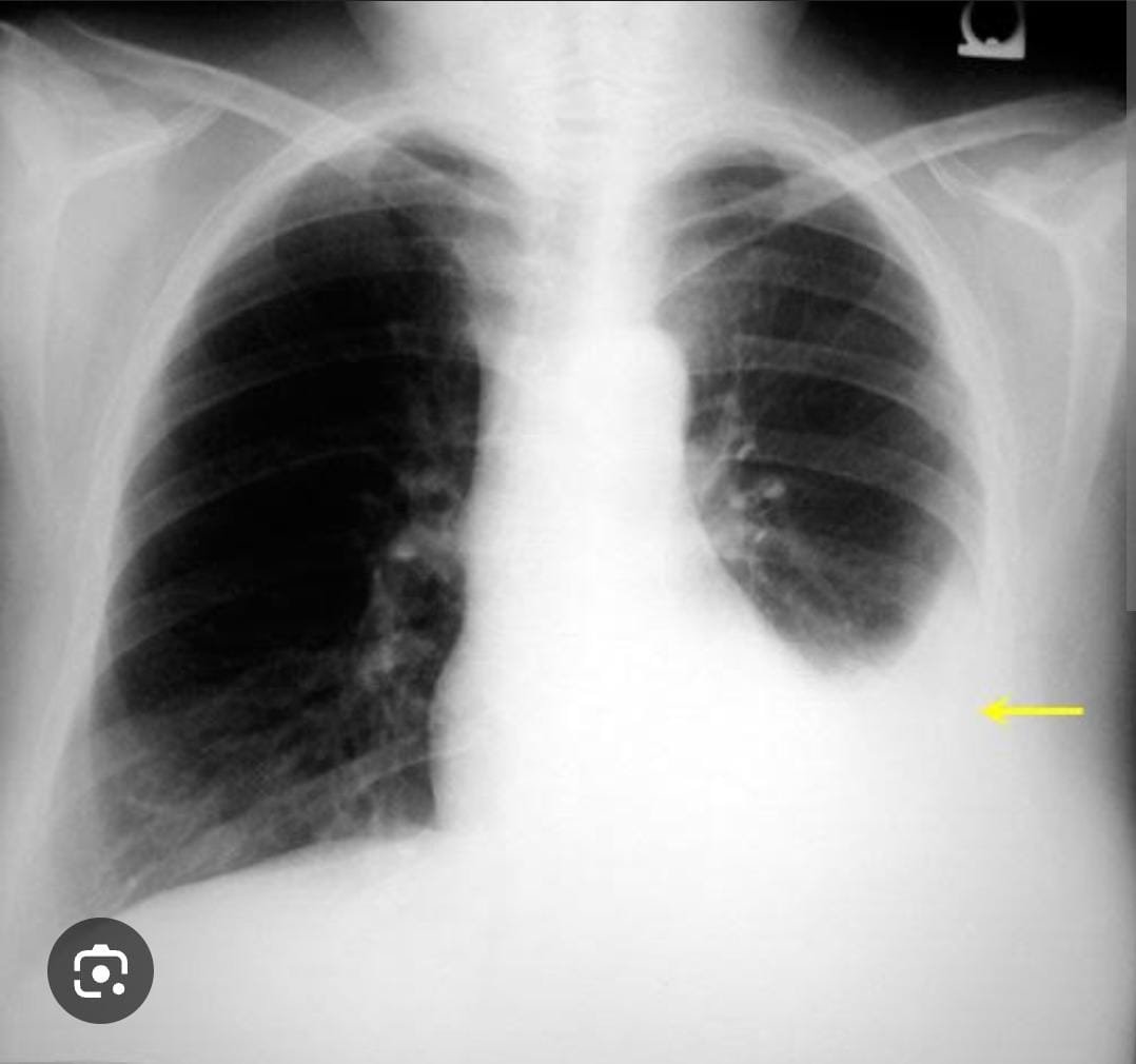 Pleural Effusion