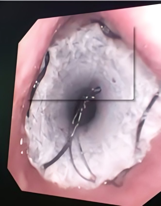 Tracheobronchial Stent