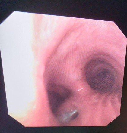 Tracheoesophageal Fistula